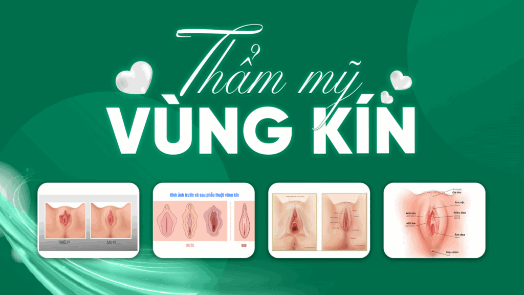 Thẩm mỹ vùng kín