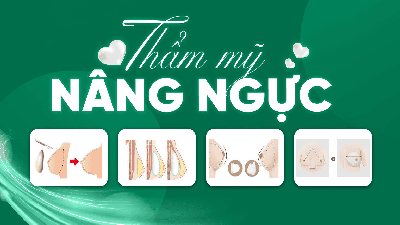 nâng ngực thẩm mỹ